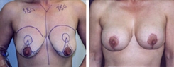 Breast Lift Patient Before & After Photo 1