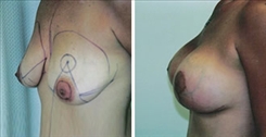 Breast Lift Patient Before & After Photo 1