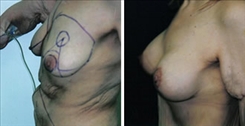 Breast Lift Patient Before & After Photo 1