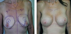 Breast Lift Patient Before & After Photo 1