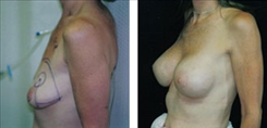 Breast Lift Patient Before & After Photo 1