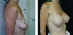 Breast Lift Patient Before & After Photo 1