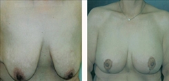 Breast Lift Patient Before & After Photo 1