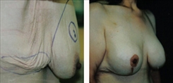 Breast Lift Patient Before & After Photo 1