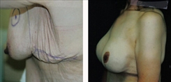 Breast Lift Patient Before & After Photo 1
