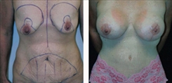 Breast Lift Patient Before & After Photo 1