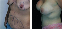 Breast Lift Patient Before & After Photo 1