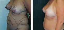 Breast Lift Patient Before & After Photo 1