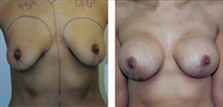 Breast Lift Patient Before & After Photo 1