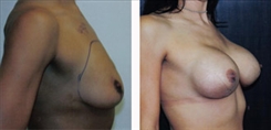 Breast Lift Patient Before & After Photo 1