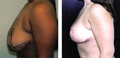 Breast Lift Patient Before & After Photo 1