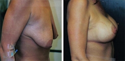 Breast Lift Patient Before & After Photo 1