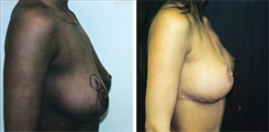 Breast Lift Patient Before & After Photo 1