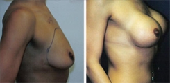 Breast Lift Patient Before & After Photo 1