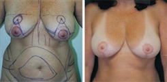 Breast Lift Patient Before & After Photo 1