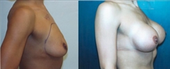 Breast Lift Patient Before & After Photo 1