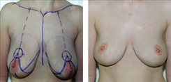 Breast Lift Patient Before & After Photo 1