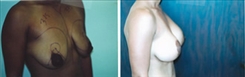 Breast Lift Patient Before & After Photo 1