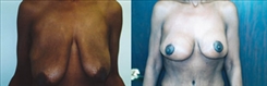 Breast Lift Patient Before & After Photo 1