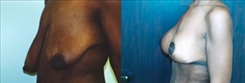 Breast Lift Patient Before & After Photo 1