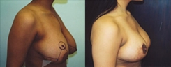 Breast Lift Patient Before & After Photo 1