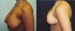 Breast Lift Patient Before & After Photo 1