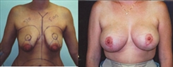 Breast Lift Patient Before & After Photo 1