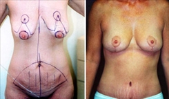 Breast Lift Patient Before & After Photo 1