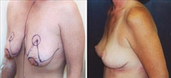 Breast Lift Patient Before & After Photo 1