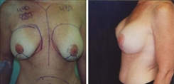 Breast Lift Patient Before & After Photo 1