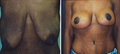 Breast Lift Patient Before & After Photo 1