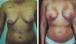 Breast Lift Patient Before & After Photo 1