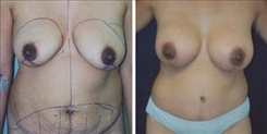 Breast Lift Patient Before & After Photo 1