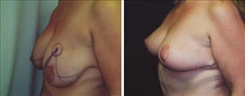 Breast Lift Patient Before & After Photo 1