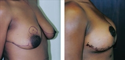 Breast Lift Patient Before & After Photo 1