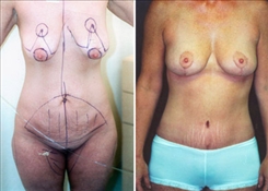 Breast Lift Patient Before & After Photo 1