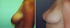 Breast Lift Patient Before & After Photo 1