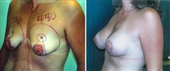 Breast Lift Patient Before & After Photo 1