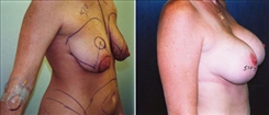 Breast Lift Patient Before & After Photo 1