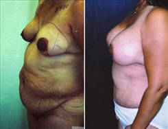 Breast Lift Patient Before & After Photo 1