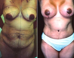 Breast Lift Patient Before & After Photo 1