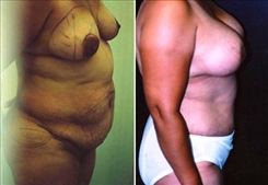 Breast Lift Patient Before & After Photo 1