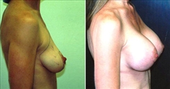 Breast Lift Patient Before & After Photo 1