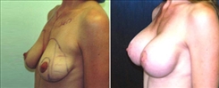 Breast Lift Patient Before & After Photo 1