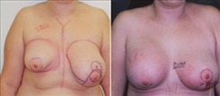 Breast Lift Patient Before & After Photo 1