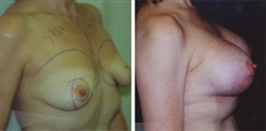 Breast Lift Patient Before & After Photo 1