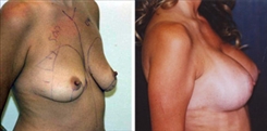 Breast Lift Patient Before & After Photo 1