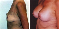 Breast Lift Patient Before & After Photo 1