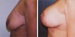 Breast Lift Patient Before & After Photo 1