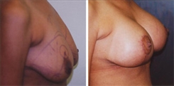 Breast Lift Patient Before & After Photo 1